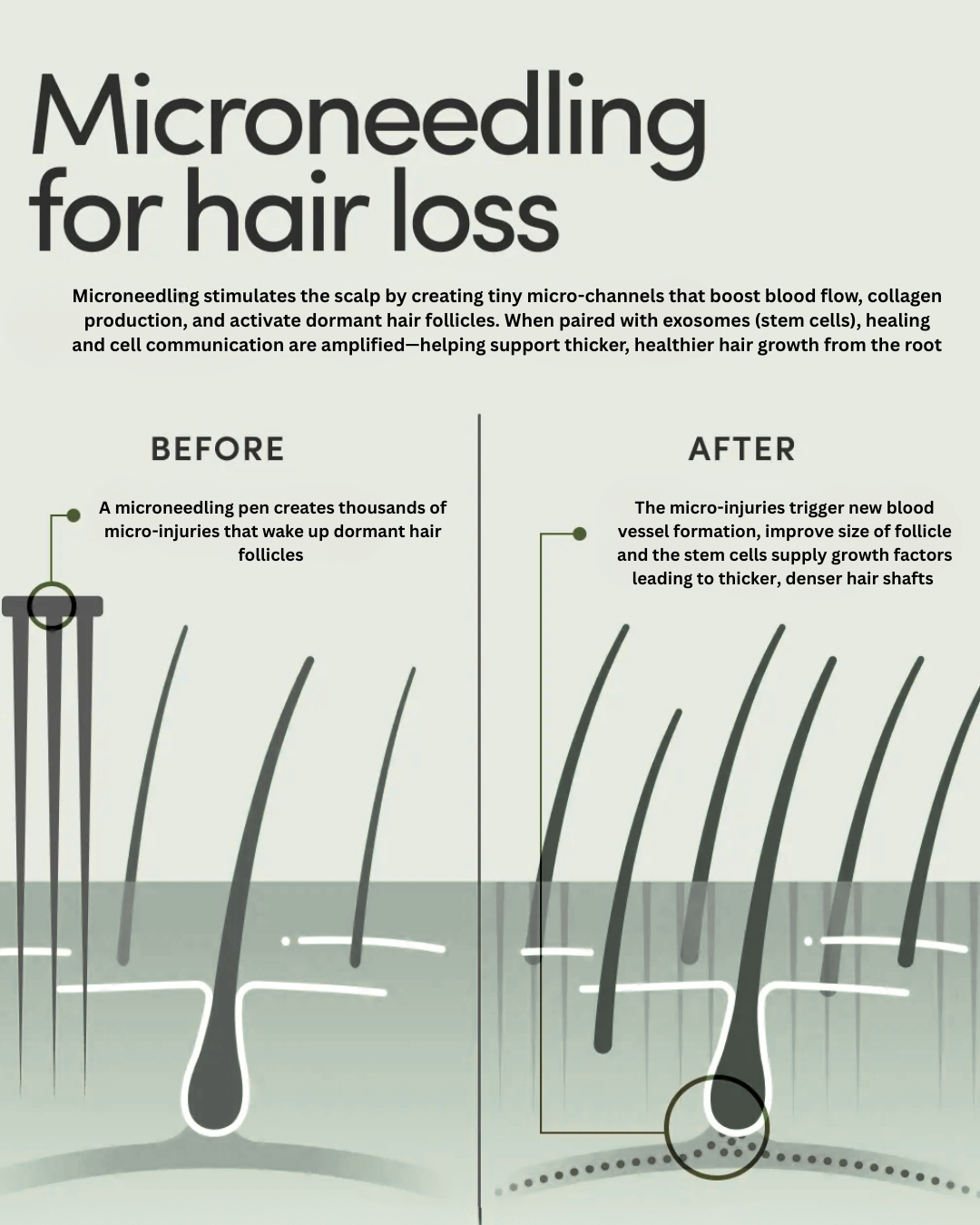 Microneedling for hair loss infographic - before and after follicle stimulation