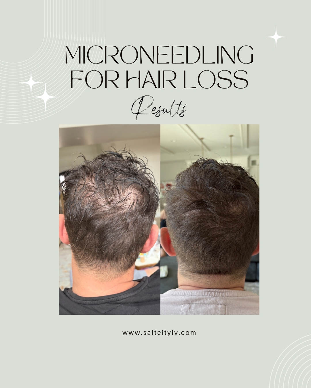 Microneedling for hair loss results - male pattern thinning improvement