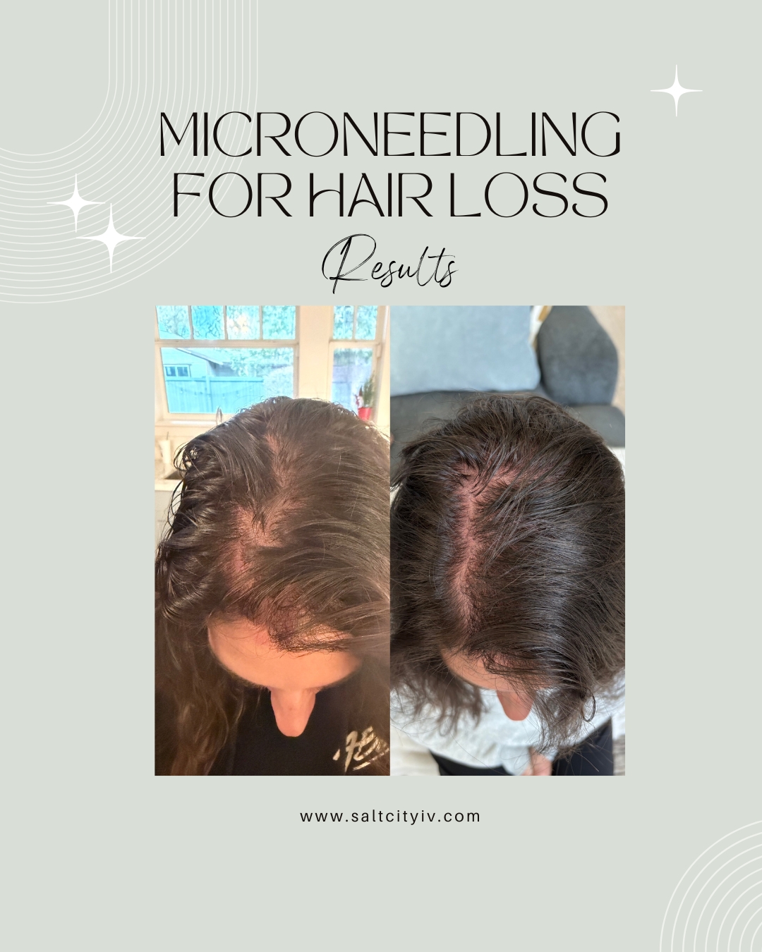 Microneedling for hair loss results - female hair thinning improvement