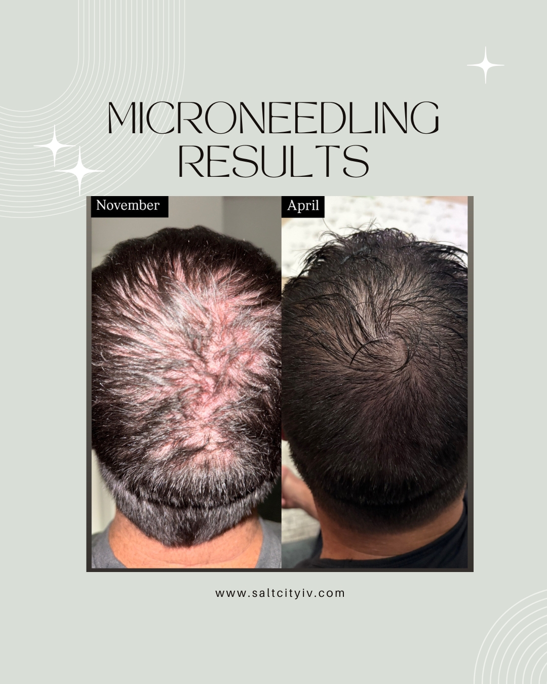 Microneedling results - crown area hair restoration November to April